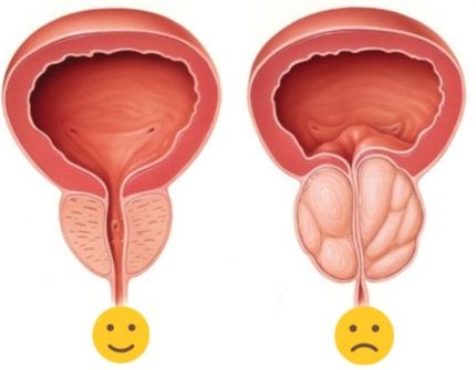 Enlarged Prostate (BPH)