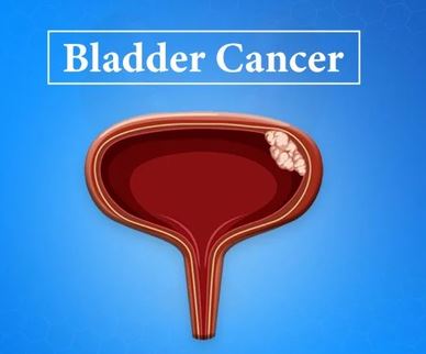 Bladder Cancer