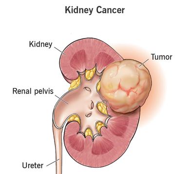 Kidney Cancer