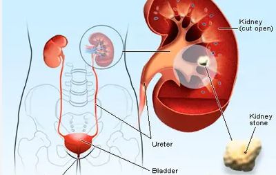 Kidney Stone
