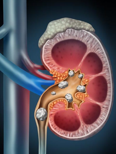 Kidney Stone