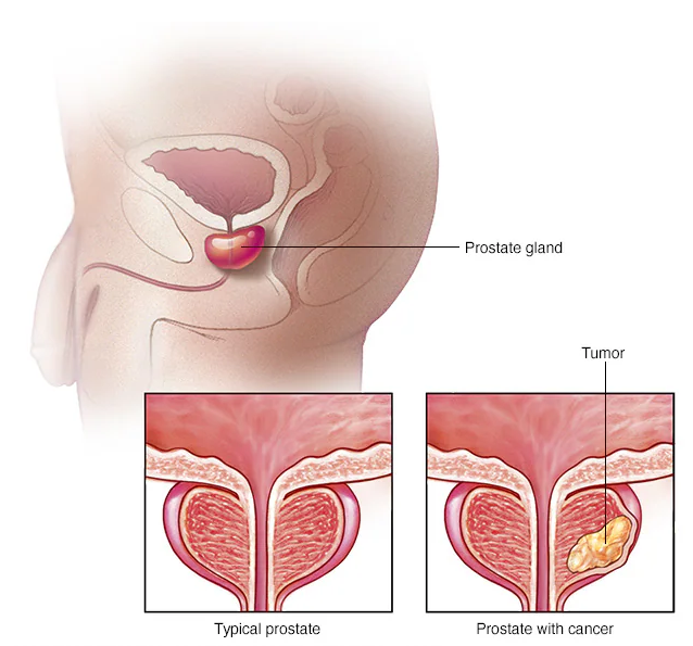 Prostate Cancer