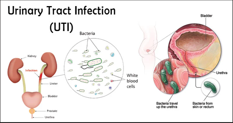 Urinary Tract Infection (UTI)