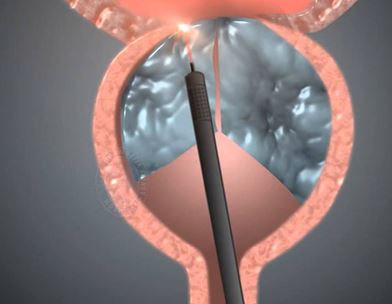 HoLEP - Holmium Laser Enucleation of Prostate