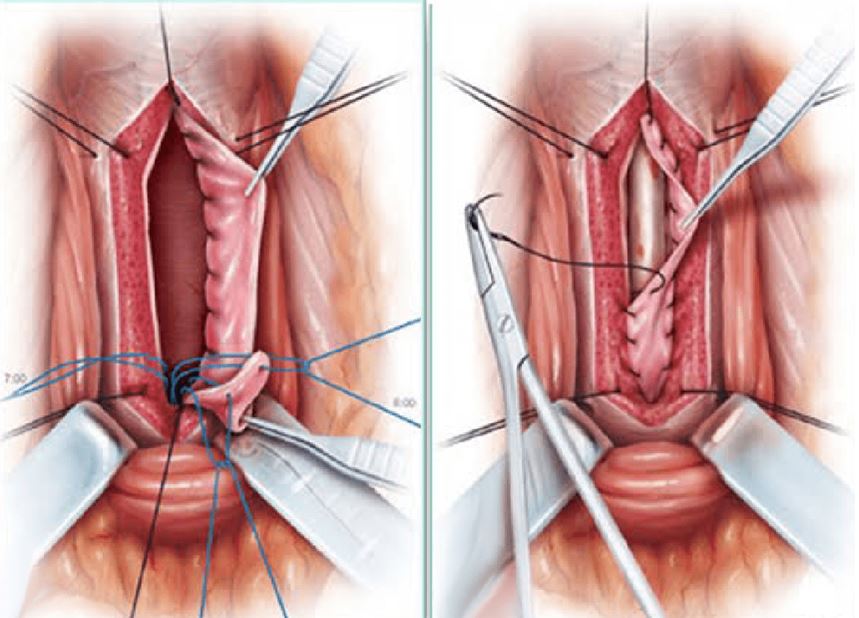 Urethroplasty